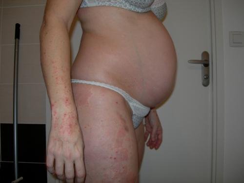 la gale femme enceinte la gale femme enceinte